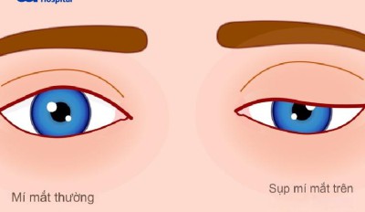 Mắt bị sụp mí sau khi ngủ dậy phải làm sao? Nguyên nhân, cách chữa